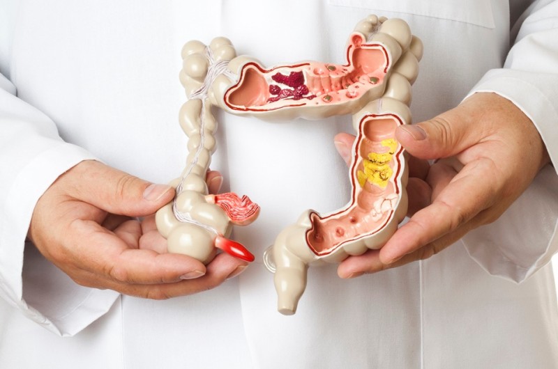 Câncer de intestino é o terceiro de maior incidência no Brasil